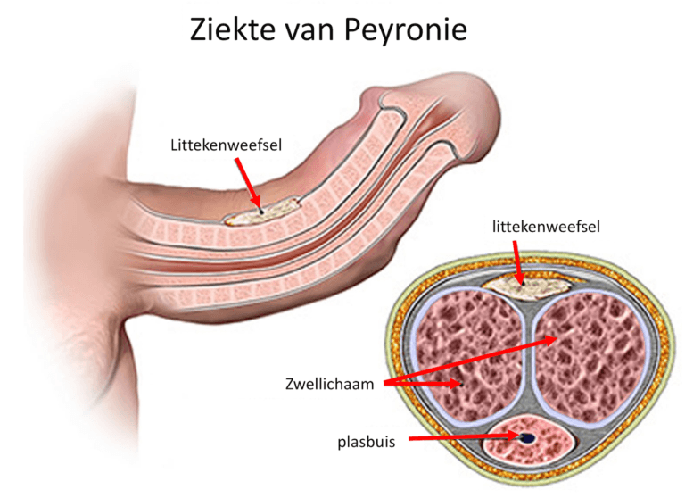 peyronie